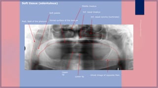Inf. nasal concha (turbinate)
Inf. nasal meatus
Dorsal surface of the tongue
Post. Wall of the pharynx
Soft palate
Lower lip
Upper
lip
Middle meatus
Ghost image of opposite Man.
Soft tissue (edentulous)
 