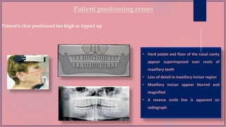 Patient positioning errors
Patient’s chin positioned too high or tipped up
• Hard palate and floor of the nasal cavity
appear superimposed over roots of
maxillary teeth
• Loss of detail in maxillary incisor region
• Maxillary incisor appear blurred and
magnified
• A reverse smile line is apparent on
radiograph
 
