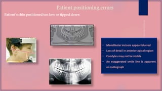Patient positioning errors
Patient’s chin positioned too low or tipped down
• Mandibular incisors appear blurred
• Loss of detail in anterior apical region
• Condyles may not be visible
• An exaggerated smile line is apparent
on radiograph
 