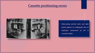 Cassette positioning errors
• Alternating vertical dark and light
bands appear on radiograph due to
improper movement of slit in
cassette holder
 
