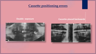 Cassette positioning errors
Double exposure Cassette placed backwards
 