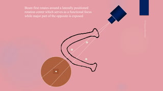 ●
●
●
Beam first rotates around a laterally positioned
rotation center which serves as a functional focus
while major part of the opposite is exposed
●
 