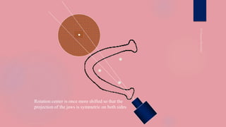 ●
●
●
Rotation center is once more shifted so that the
projection of the jaws is symmetric on both sides
●
 