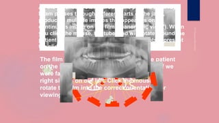 As the tubehead rotates around the patient, the x-ray
beam passes through different parts of the jaws,
producing multiple images that appear as one
continuous image on the film (“panoramic view”). When
you click the mouse, the tubehead will rotate around the
patient and produce the images. The red dots represent
the sliding rotation center.
The film above shows the left side of the patient
on the left. We normally look at the film as if we
were facing the patient, so that the patient’s
right side is on our left. Click the mouse to
rotate the film into the correct orientation for
viewing .
 