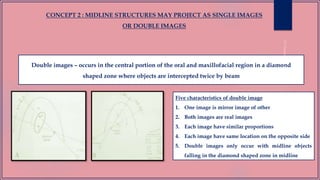 Double images – occurs in the central portion of the oral and maxillofacial region in a diamond
shaped zone where objects are intercepted twice by beam
Five characteristics of double image
1. One image is mirror image of other
2. Both images are real images
3. Each image have similar proportions
4. Each image have same location on the opposite side
5. Double images only occur with midline objects
falling in the diamond shaped zone in midline
CONCEPT 2 : MIDLINE STRUCTURES MAY PROJECT AS SINGLE IMAGES
OR DOUBLE IMAGES
 