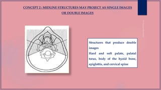 Structures that produce double
images
Hard and soft palate, palatal
torus, body of the hyoid bone,
epiglottis, and cervical spine
CONCEPT 2 : MIDLINE STRUCTURES MAY PROJECT AS SINGLE IMAGES
OR DOUBLE IMAGES
 