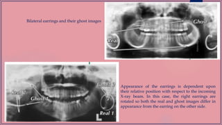 Bilateral earrings and their ghost images
Appearance of the earrings is dependent upon
their relative position with respect to the incoming
X-ray beam. In this case, the right earrings are
rotated so both the real and ghost images differ in
appearance from the earring on the other side.
 