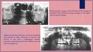 Sharp opaque images on the left side of the image are
buckshot. The indistinct opaque images on the right
side are ghost images
Tongue rings have become evermore frequent.
The patient is often reluctant to remove this
device. It can case a radiopaque shadow
upwards superimposed in the midline over the
nasal passageway.
 