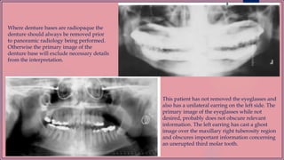 Where denture bases are radiopaque the
denture should always be removed prior
to panoramic radiology being performed.
Otherwise the primary image of the
denture base will exclude necessary details
from the interpretation.
This patient has not removed the eyeglasses and
also has a unilateral earring on the left side. The
primary image of the eyeglasses while not
desired, probably does not obscure relevant
information. The left earring has cast a ghost
image over the maxillary right tuberosity region
and obscures important information concerning
an unerupted third molar tooth.
 