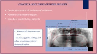 CONCEPT 4 : SOFT TISSUE OUTLINES ARE SEEN
 Due to attenuation of the beam of radiations
 Posterior and superior regions
 Seen best in edentulous patients
 Common soft tissue structures
seen:
Ear, nose, epiglottis, cartilage, soft
palate, uvula,tongue,posterior
pharyngeal wall etc
 