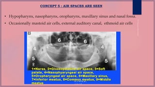 CONCEPT 5 : AIR SPACES ARE SEEN
• Hypopharynx, nasopharynx, oropharynx, maxillary sinus and nasal fossa.
• Occasionally mastoid air cells, external auditory canal, ethmoid air cells
 