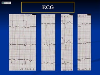 ECG 