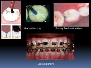 Pits and fissures              Primary Teeth restorations




             Bracket Bonding
 