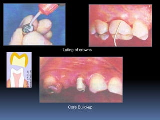 Luting of crowns




  Core Build-up
 