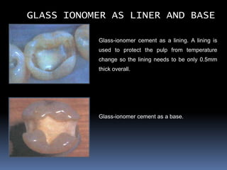 GLASS IONOMER AS LINER AND BASE

           Glass-ionomer cement as a lining. A lining is
           used to protect the pulp from temperature
           change so the lining needs to be only 0.5mm
           thick overall.




           Glass-ionomer cement as a base.
 