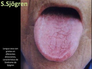 Lengua seca con
    grietas en
   diferentes
  direcciones,
característico de
  Síndrome de
     Sjögren
 