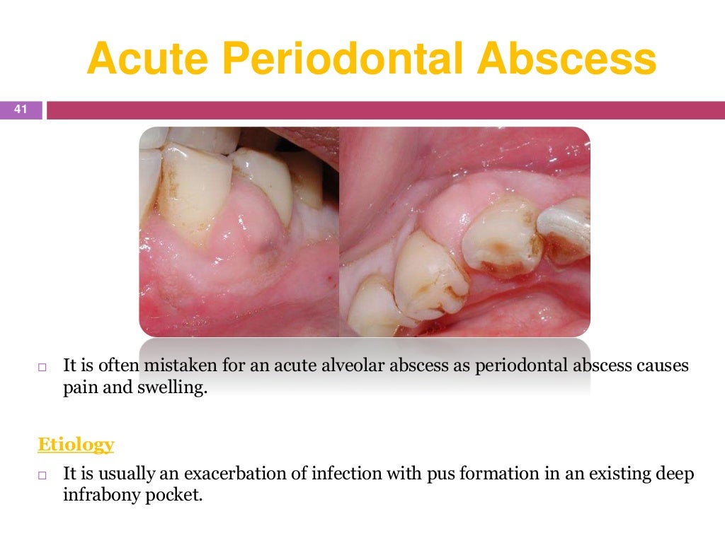 endodontic emergencies