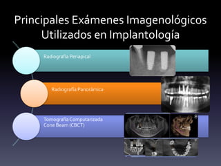 Principales Exámenes Imagenológicos
Utilizados en Implantología
Radiografía Periapical
Radiografía Panorámica
TomografíaComputarizada
Cone Beam (CBCT)
 