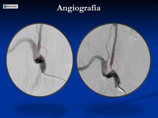 Angiografía  
