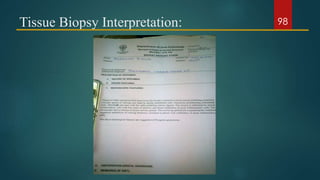 Tissue Biopsy Interpretation: 98
 