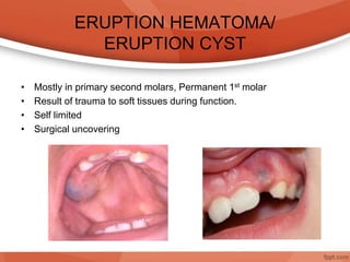 ERUPTION HEMATOMA/
ERUPTION CYST
• Mostly in primary second molars, Permanent 1st molar
• Result of trauma to soft tissues during function.
• Self limited
• Surgical uncovering
 