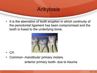 Ankylosis
• It is the aberration of tooth eruption in which continuity of
the periodontal ligament has been compromised and the
tooth is fused to the underlying bone.
• C/f:
• Common- mandibular primary molars.
anterior primary tooth- due to trauma
 
