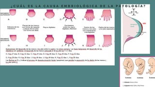 Focomelia Rx CASO CLINICO DE HISTOLOGIA FOCOMELIA EN RECIEN NACIDOS | PDF