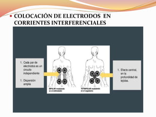  COLOCACIÓN DE ELECTRODOS EN
CORRIENTES INTERFERENCIALES
 