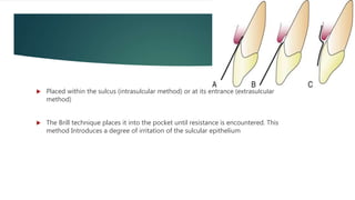  Placed within the sulcus (intrasulcular method) or at its entrance (extrasulcular
method)
 The Brill technique places it into the pocket until resistance is encountered. This
method Introduces a degree of irritation of the sulcular epithelium
 