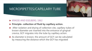MICROPIPETTES/CAPILLARY TUBE
 KRASSE AND EGELBERG. 1962
 Principle- collection of fluid by capillary action.
 After isolation and drying of collection site, capillary tubes of
known diameter are inserted into the entrance of gingival
crevice, GCF migrates into the tube by capillary action.
 As diameter is known, the amount of GCF can be calculated
by measuring the distance which the GCF has migrated
 