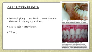 ORAL LICHEN PLANUS:
 Immunologically mediated mucocutaneous
disorder - T cells play a central role.
 Middle aged & older women
 2:1 ratio
 