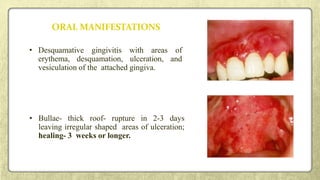 ORAL MANIFESTATIONS
• Desquamative gingivitis with areas of
erythema, desquamation, ulceration, and
vesiculation of the attached gingiva.
• Bullae- thick roof- rupture in 2-3 days
leaving irregular shaped areas of ulceration;
healing- 3 weeks or longer.
 