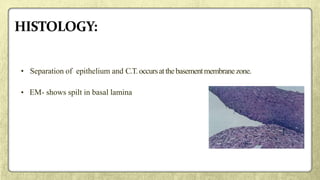 • Separation of epithelium and C.T.occursatthebasementmembranezone.
• EM- shows spilt in basal lamina
 