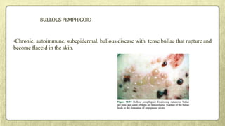 BULLOUS PEMPHIGOID
•Chronic, autoimmune, subepidermal, bullous disease with tense bullae that rupture and
become flaccid in the skin.
 