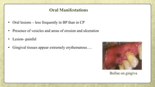 Oral Manifestations
• Oral lesions – less frequently in BP than in CP
• Presence of vesicles and areas of erosion and ulceration
• Lesion- painful
• Gingival tissues appear extremely erythematous….
Bullae on gingiva
 