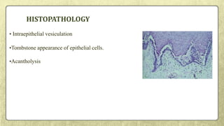 HISTOPATHOLOGY
• Intraepithelial vesiculation
•Tombstone appearance of epithelial cells.
•Acantholysis
 
