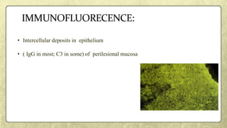 • Intercellular deposits in epithelium
• ( IgG in most; C3 in some) of perilesional mucosa
 