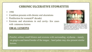 CHRONIC ULCERATIVE STOMATITIS
• 1990
• Condition presents with chronic oral ulcerations
• Predilection for women(4th decade)
• Erosions and ulcerations in oral cavity- few cases
with cutaneous lesions
ORAL LESIONS
•Painful, solitary small blisters and erosions with surrounding erythema – mainly
on gingiva and lateral border of the tongue ; hard palate may also present similar
lesions.
 