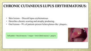 • Skin lesions – Discoid lupus erythematosus
• Describes chronic scarring and atrophy producing..
• Oral lesions - 9% of patients present lichen planus-like plaques..
Soft palate > buccal mucosa > tongue > lower labial mucosa > gingiva
 