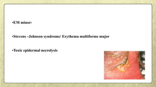 •EM minor-
•Stevens –Johnson syndrome/ Erythema multiforme major
•Toxic epidermal necrolysis
 
