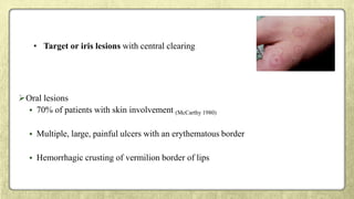 • Target or iris lesions with central clearing
Oral lesions
• 70% of patients with skin involvement (McCarthy 1980)
• Multiple, large, painful ulcers with an erythematous border
• Hemorrhagic crusting of vermilion border of lips
 