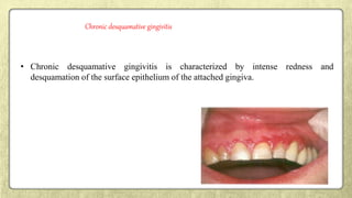 • Chronic desquamative gingivitis is characterized by intense redness and
desquamation of the surface epithelium of the attached gingiva.
Chronic desquamative gingivitis
 