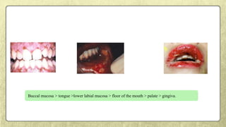 Buccal mucosa > tongue >lower labial mucosa > floor of the mouth > palate > gingiva.
 