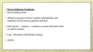 Steven Johnsons Syndrome
• Severe bullous form
• Abrupt occurrence of fever, malaise, photophobia and
eruptions of oral mucosa, genitilia and skin
• Oral lesions → rupture → surfaces covered with thick white
or yellow exudate
• Lips - ulceration with bloody crusting
• ANUG
 