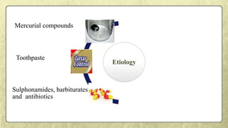 Etiology
Sulphonamides, barbiturates
and antibiotics
Mercurial compounds
Toothpaste
 