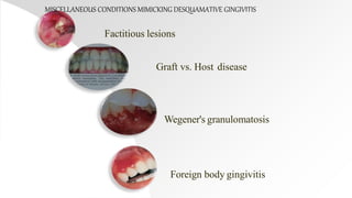 Factitious lesions
Graft vs. Host disease
Wegener's granulomatosis
Foreign body gingivitis
MISCELLANEOUS CONDITIONS MIMICKING DESQUAMATIVE GINGIVITIS
 