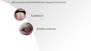 Candidiasis
MISCELLANEOUS CONDITIONS MIMICKING DESQUAMATIVE GINGIVITIS
Kindler syndrome
 