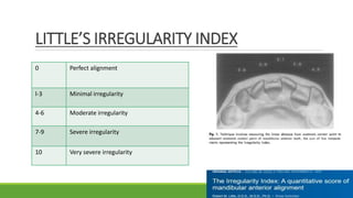 LITTLE’S IRREGULARITY INDEX
0 Perfect alignment
l-3 Minimal irregularity
4-6 Moderate irregularity
7-9 Severe irregularity
10 Very severe irregularity
 
