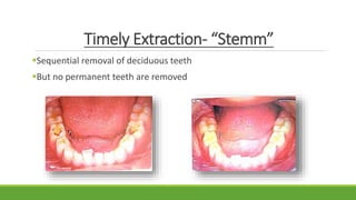 Timely Extraction- “Stemm”
Sequential removal of deciduous teeth
But no permanent teeth are removed
 