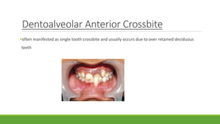 Dentoalveolar Anterior Crossbite
often manifested as single tooth crossbite and usually occurs due to over retained deciduous
teeth
 